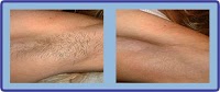 Laser Hair Removal Group 378544 Image 0